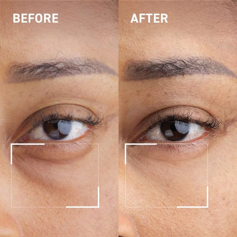 Skinry Store before and after close up of under eye showing reduced bags using best eye gel for puffiness
